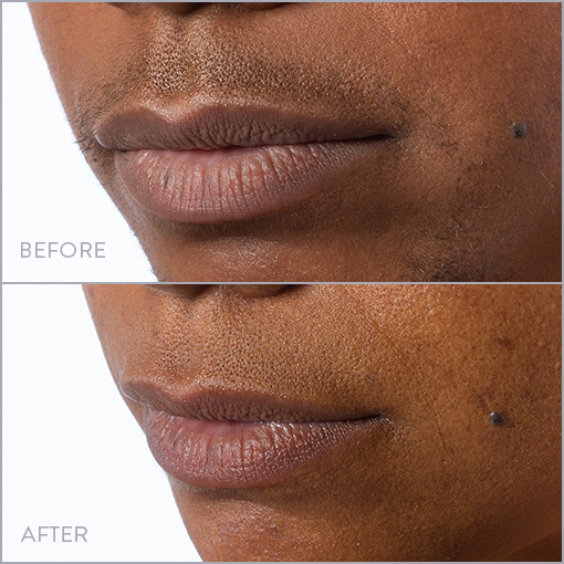 Lip & Chin Laser Hair Removal Photo, Before & After